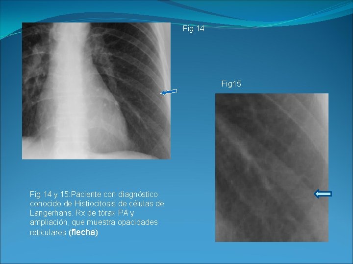 Fig 14 Fig 15 Fig 14 y 15: Paciente con diagnóstico conocido de Histiocitosis