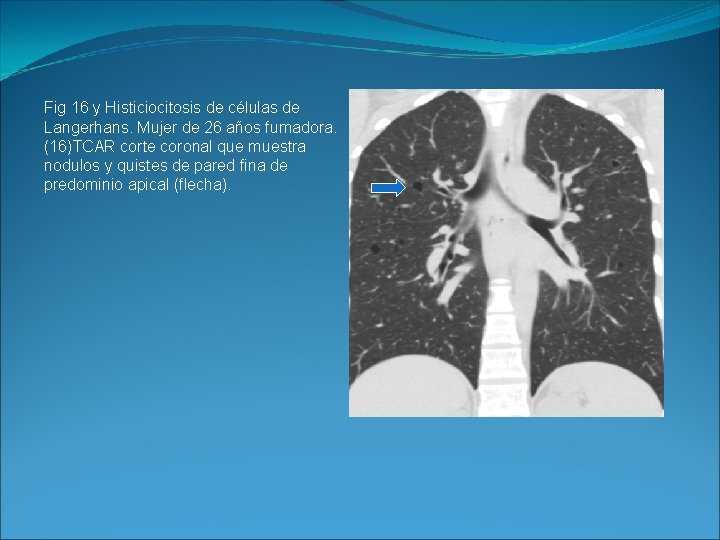 Fig 16 y Histiciocitosis de células de Langerhans. Mujer de 26 años fumadora. (16)TCAR
