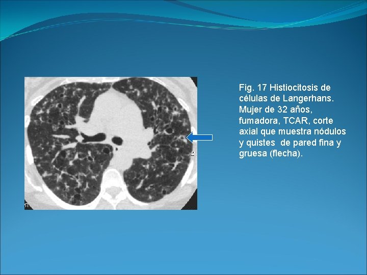 Fig. 17 Histiocitosis de células de Langerhans. Mujer de 32 años, fumadora, TCAR, corte