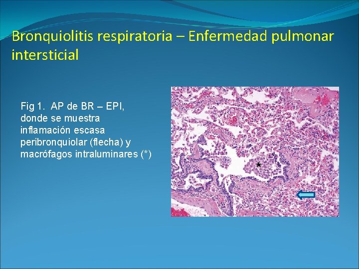 Bronquiolitis respiratoria – Enfermedad pulmonar intersticial Fig 1. AP de BR – EPI, donde