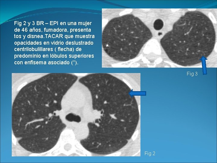 Fig 2 y 3 BR – EPI en una mujer de 46 años, fumadora,