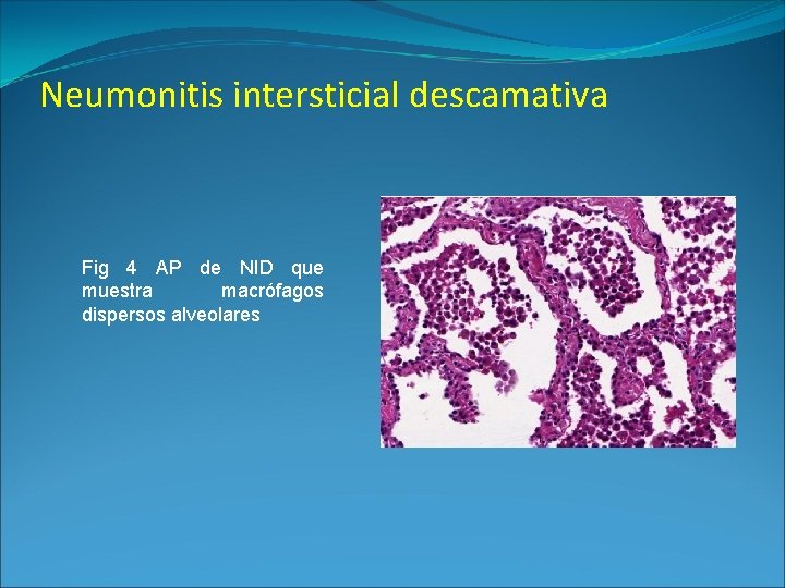 Neumonitis intersticial descamativa Fig 4 AP de NID que muestra macrófagos dispersos alveolares 