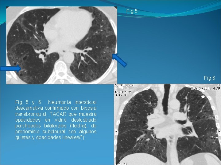 Fig 5 Fig 6 Fig 5 y 6 Neumonía intersticial descamativa confirmado con biopsia