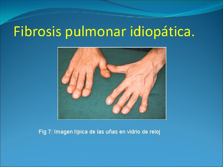 Fibrosis pulmonar idiopática. Fig 7: Imagen típica de las uñas en vidrio de reloj