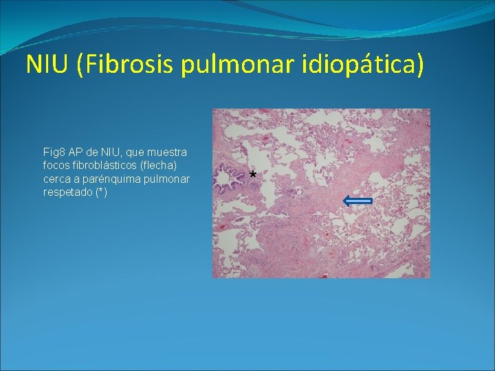 NIU (Fibrosis pulmonar idiopática) Fig 8 AP de NIU, que muestra focos fibroblásticos (flecha)
