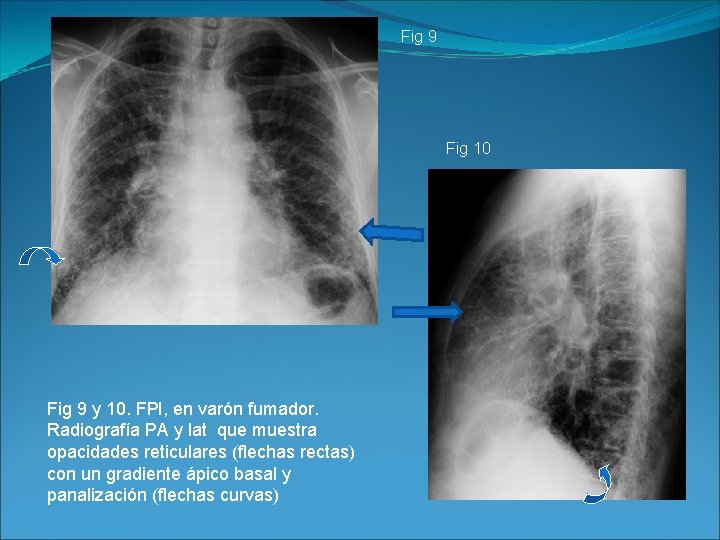 Fig 9 Fig 10 Fig 9 y 10. FPI, en varón fumador. Radiografía PA