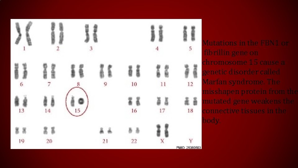 Mutations in the FBN 1 or fibrillin gene on chromosome 15 cause a genetic