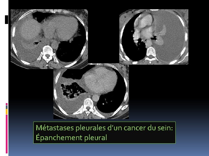 Métastases pleurales d’un cancer du sein: Épanchement pleural 