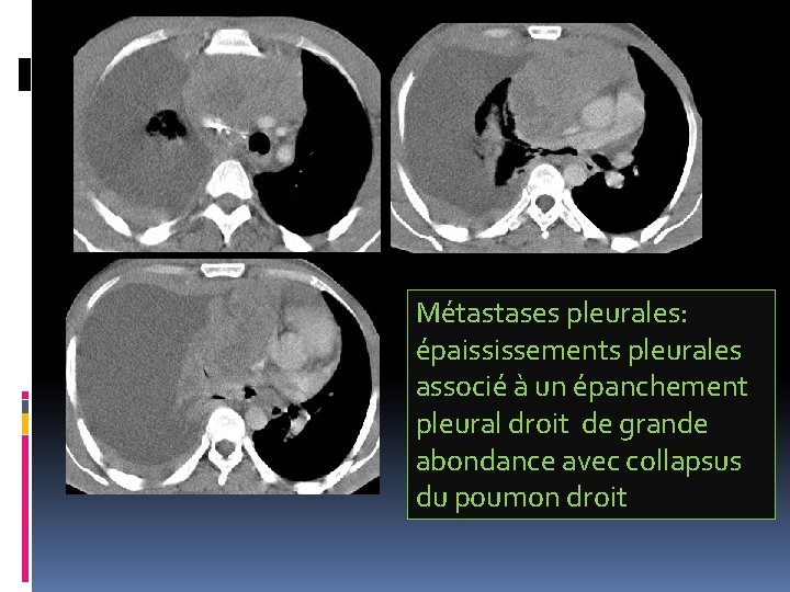 Métastases pleurales: épaississements pleurales associé à un épanchement pleural droit de grande abondance avec