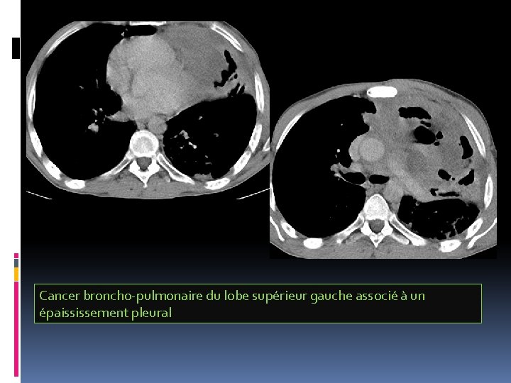 Cancer broncho-pulmonaire du lobe supérieur gauche associé à un épaississement pleural 