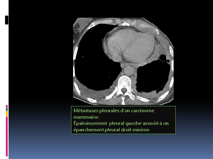 Métastases pleurales d’un carcinome mammaire: Épaississement pleural gauche associé à un épanchement pleural droit