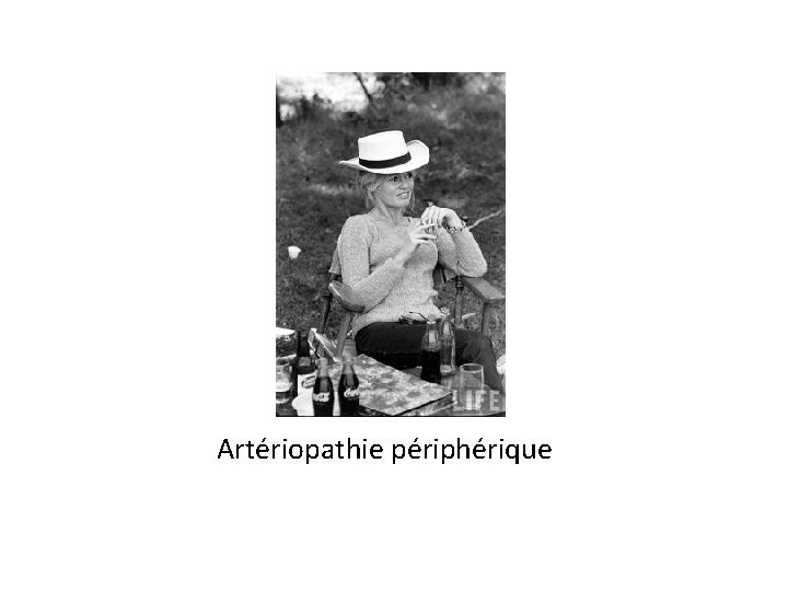 Artériopathie périphérique 