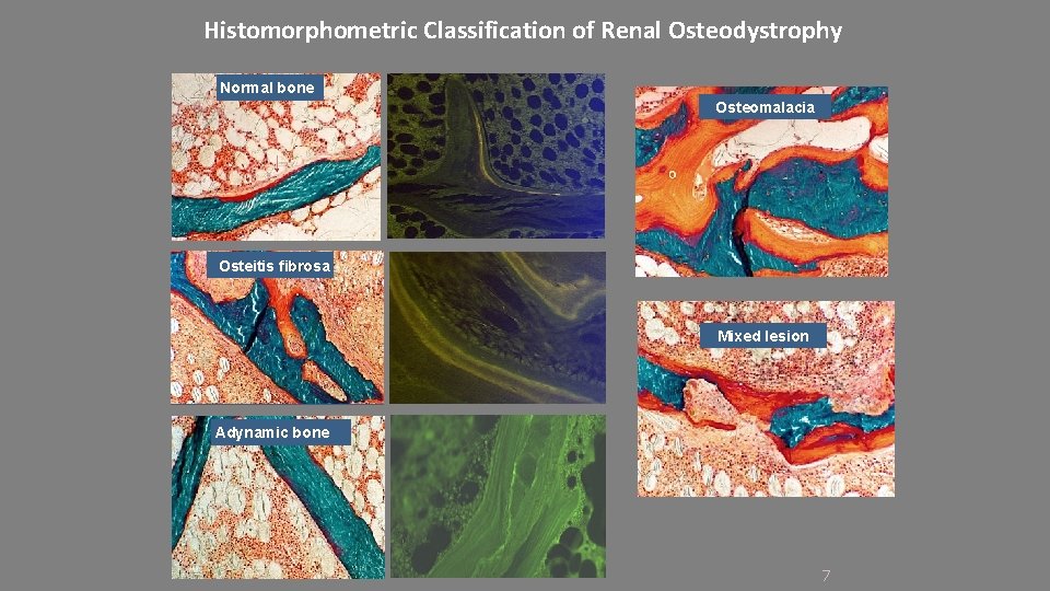 Histomorphometric Classification of Renal Osteodystrophy Normal bone Osteomalacia Osteitis fibrosa Mixed lesion Adynamic bone