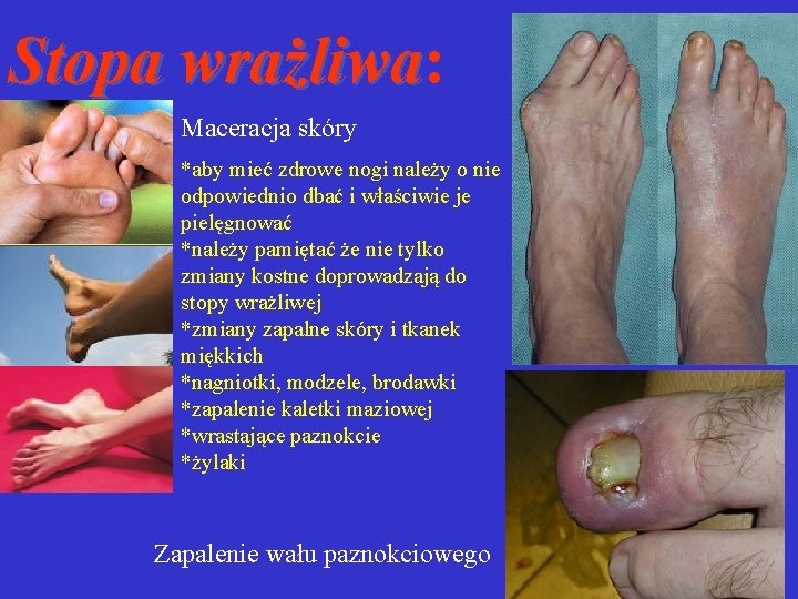 Stopa wrażliwa: wrażliwa Maceracja skóry *aby mieć zdrowe nogi należy o nie odpowiednio dbać