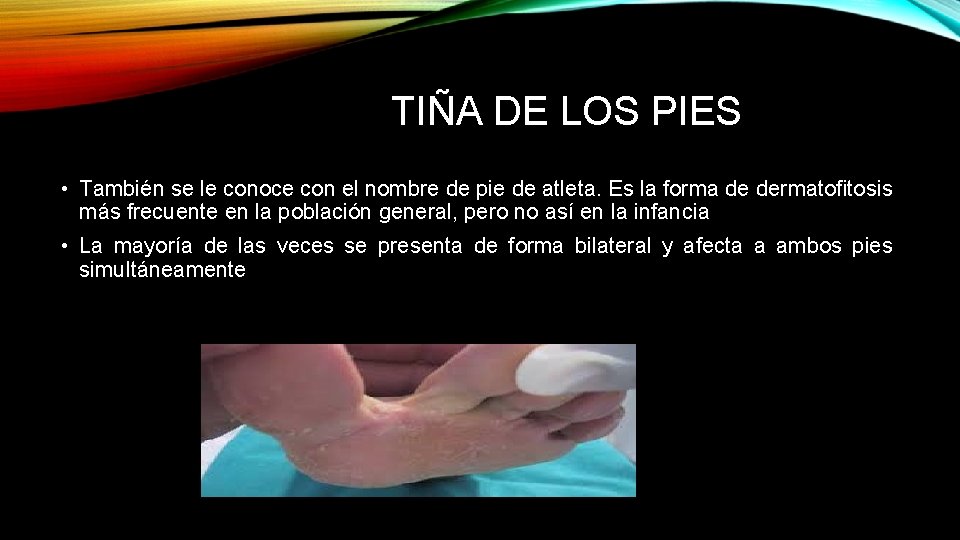 TIÑA DE LOS PIES • También se le conoce con el nombre de pie