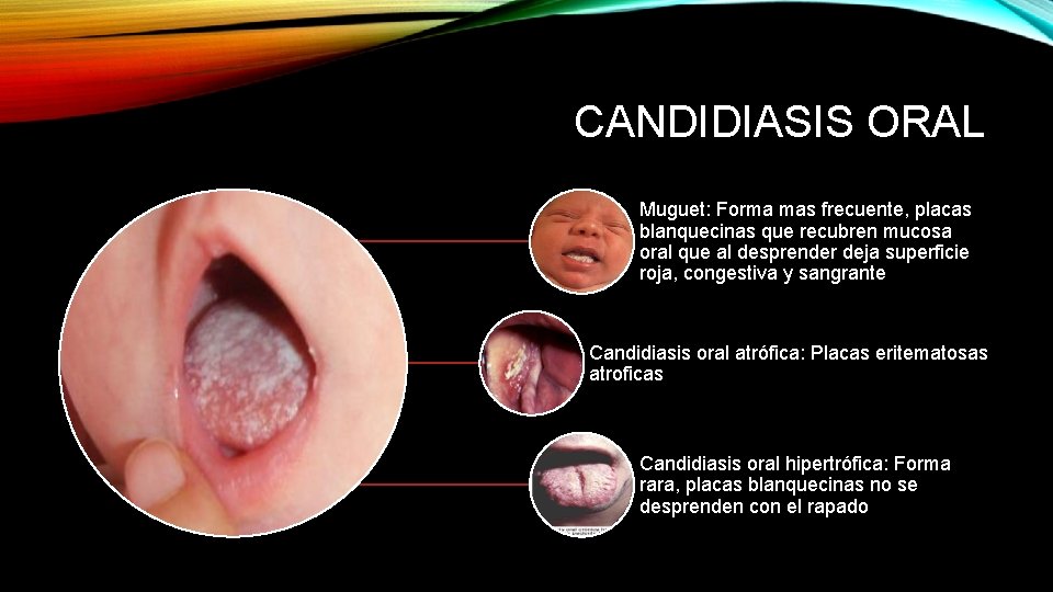 CANDIDIASIS ORAL Muguet: Forma mas frecuente, placas blanquecinas que recubren mucosa oral que al