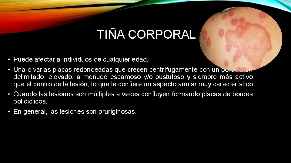 TIÑA CORPORAL • Puede afectar a individuos de cualquier edad. • Una o varias