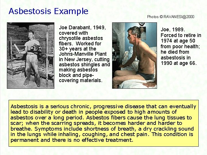 Asbestosis Example Joe Darabant, 1949, covered with chrysotile asbestos fibers. Worked for 30+ years