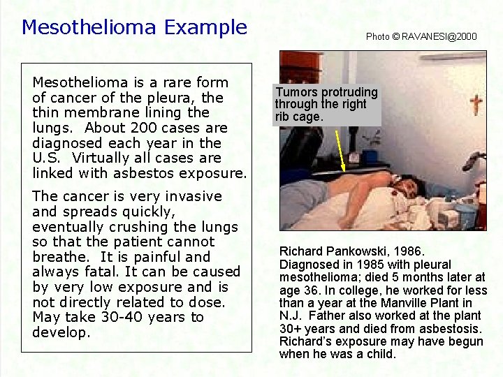 Mesothelioma Example Mesothelioma is a rare form of cancer of the pleura, the thin