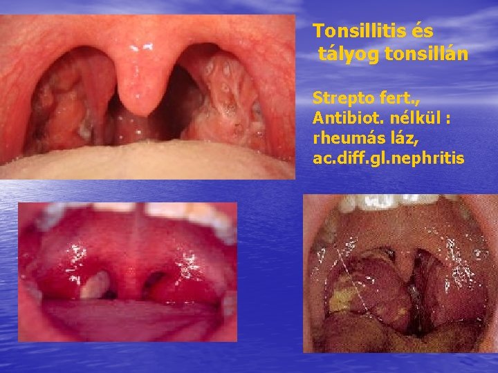 Tonsillitis és tályog tonsillán Strepto fert. , Antibiot. nélkül : rheumás láz, ac. diff. Tonsillitis és tályog tonsillán Strepto fert. , Antibiot. nélkül : rheumás láz, ac. diff.