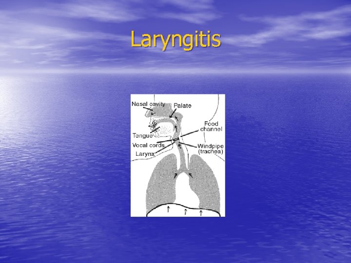 Laryngitis Laryngitis