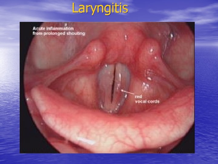 Laryngitis Laryngitis