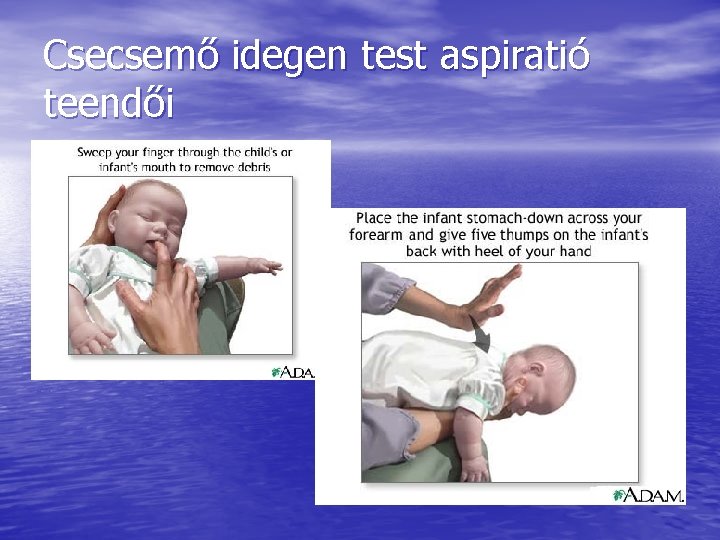Csecsemő idegen test aspiratió teendői Csecsemő idegen test aspiratió teendői