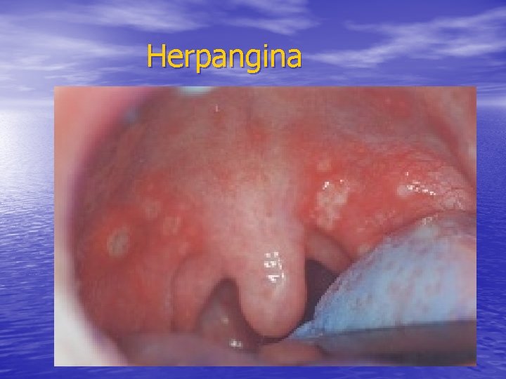 Herpangina Herpangina