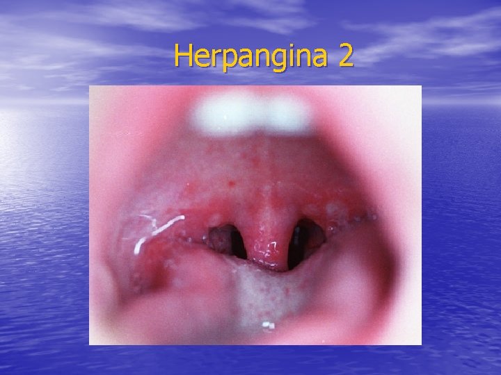 Herpangina 2 Herpangina 2