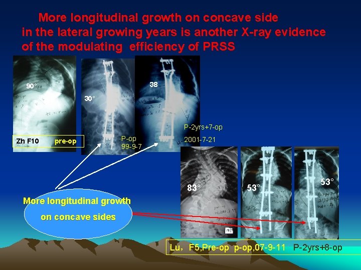 More longitudinal growth on concave side in the lateral growing years is another X-ray