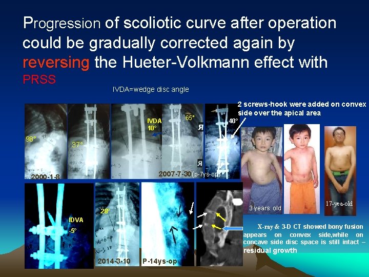 Progression of scoliotic curve after operation could be gradually corrected again by reversing the