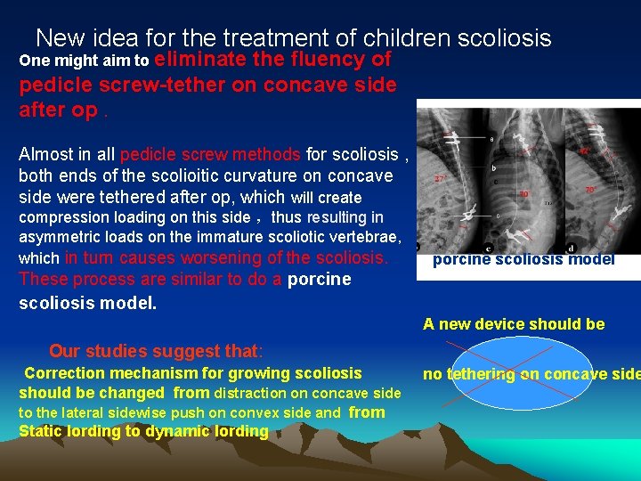 New idea for the treatment of children scoliosis One might aim to eliminate the