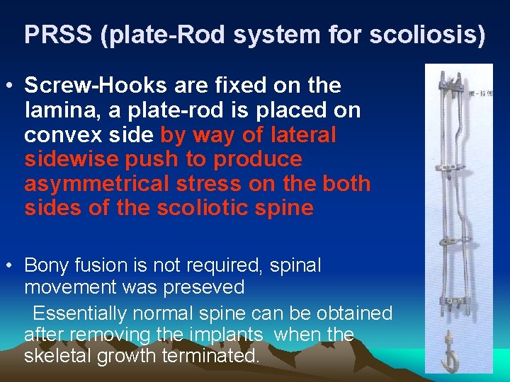 PRSS (plate-Rod system for scoliosis) • Screw-Hooks are fixed on the lamina, a plate-rod