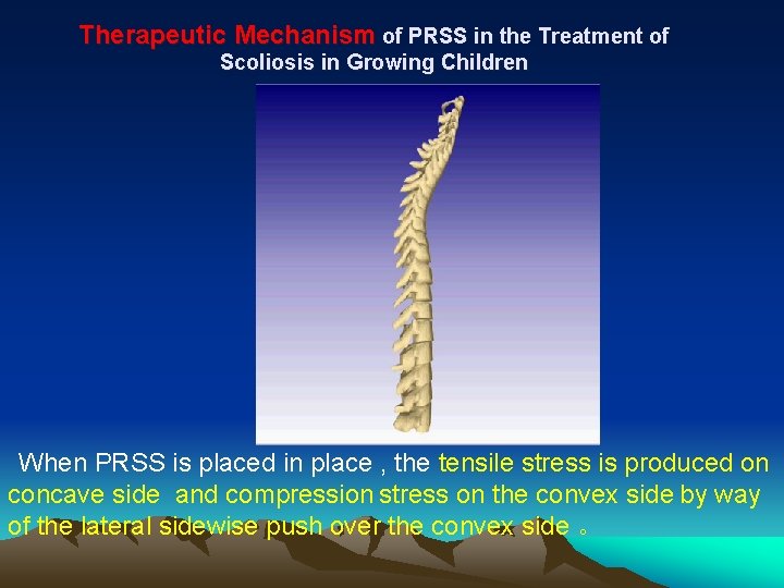 Therapeutic Mechanism of PRSS in the Treatment of Scoliosis in Growing Children When PRSS