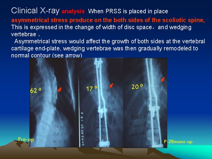 Clinical X-ray analysis When PRSS is placed in place asymmetrical stress produce on the