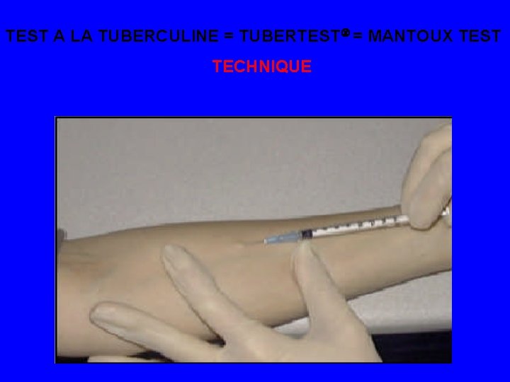TEST A LA TUBERCULINE = TUBERTEST = MANTOUX TEST TECHNIQUE 