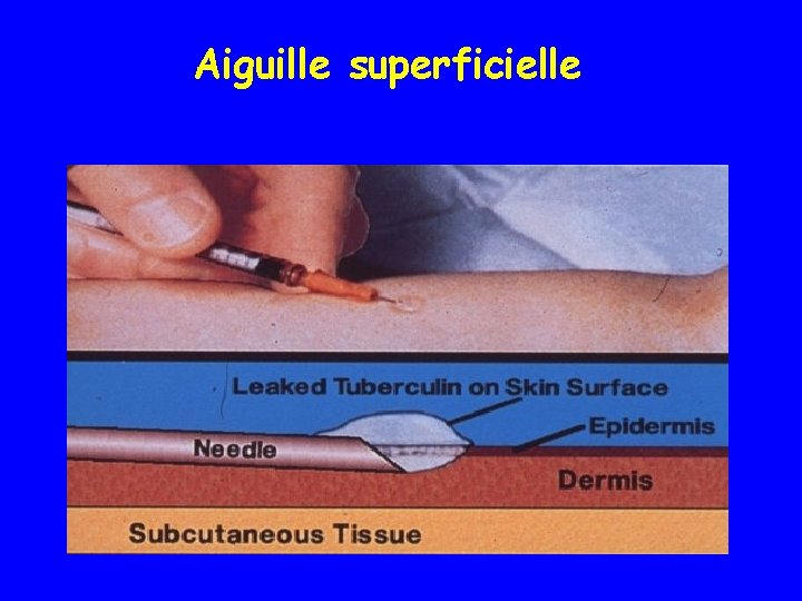 Aiguille superficielle Needle Too Shallow 