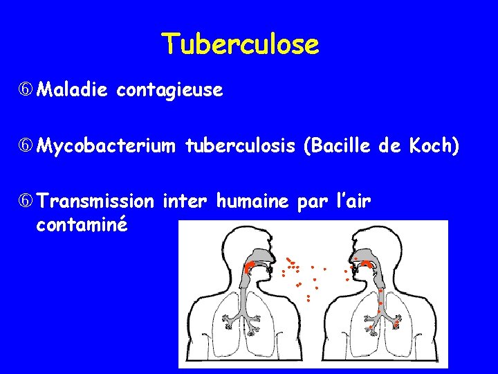 Tuberculose Maladie contagieuse Mycobacterium tuberculosis (Bacille de Koch) Transmission inter humaine par l’air contaminé