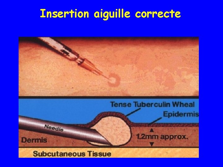 Insertion aiguille correcte 