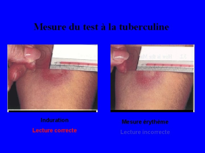 Mesure du test à la tuberculine Induration Mesure érythème Lecture correcte Lecture incorrecte 