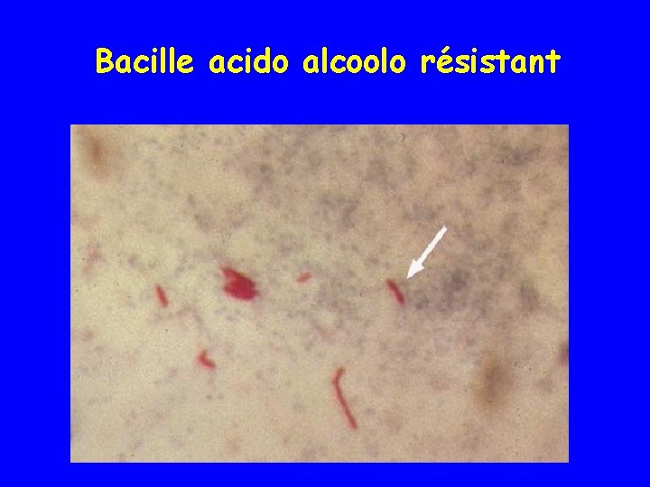 Bacille acido alcoolo résistant 