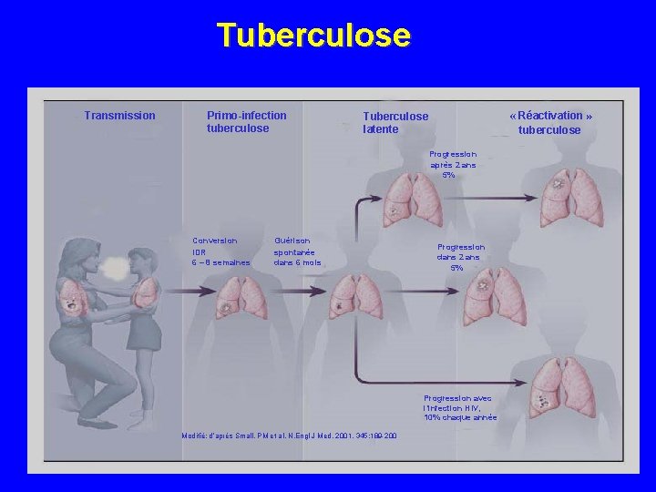Tuberculose Transmission Primo-infection tuberculose « Réactivation » tuberculose Tuberculose latente Progression après 2 ans