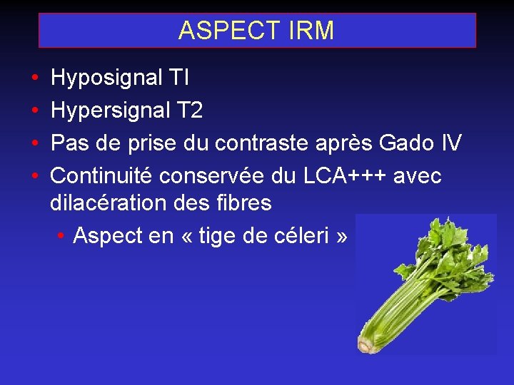 ASPECT IRM • • Hyposignal TI Hypersignal T 2 Pas de prise du contraste