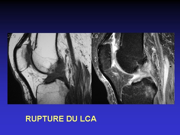 RUPTURE DU LCA 