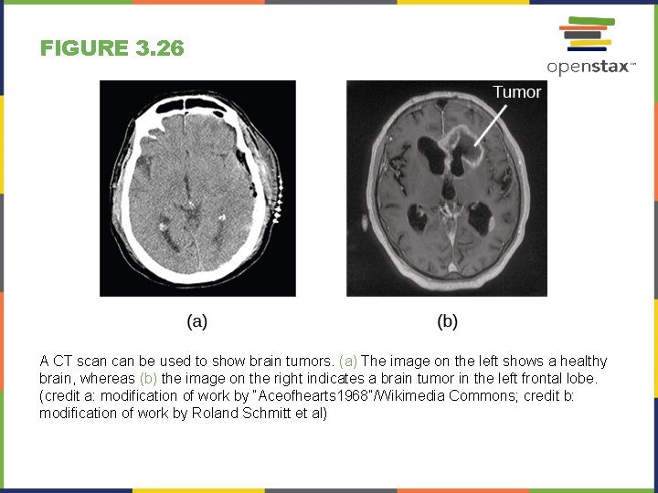 FIGURE 3. 26 A CT scan be used to show brain tumors. (a) The