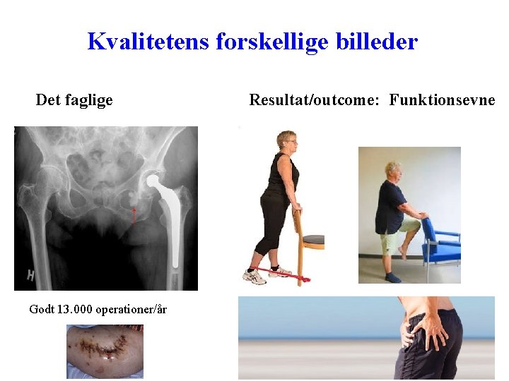 Kvalitetens forskellige billeder Det faglige Godt 13. 000 operationer/år Resultat/outcome: Funktionsevne 