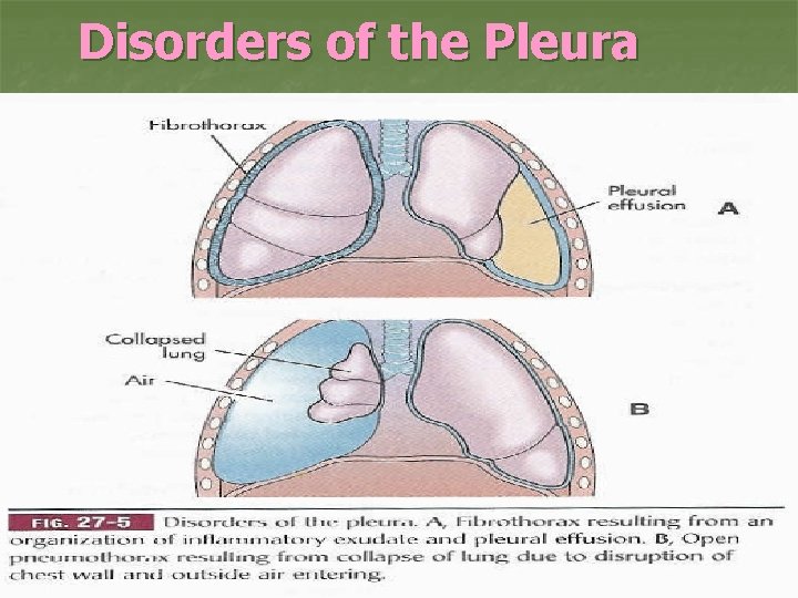 Disorders of the Pleura 