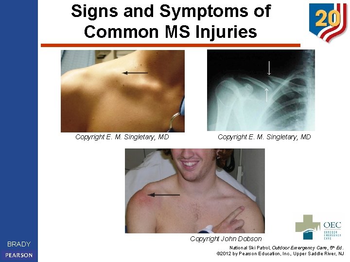 Signs and Symptoms of Common MS Injuries Copyright E. M. Singletary, MD BRADY Copyright