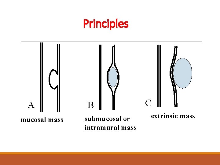 Principles A mucosal mass B submucosal or intramural mass C extrinsic mass 