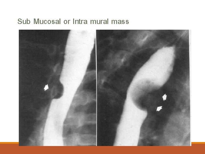 Sub Mucosal or Intra mural mass 